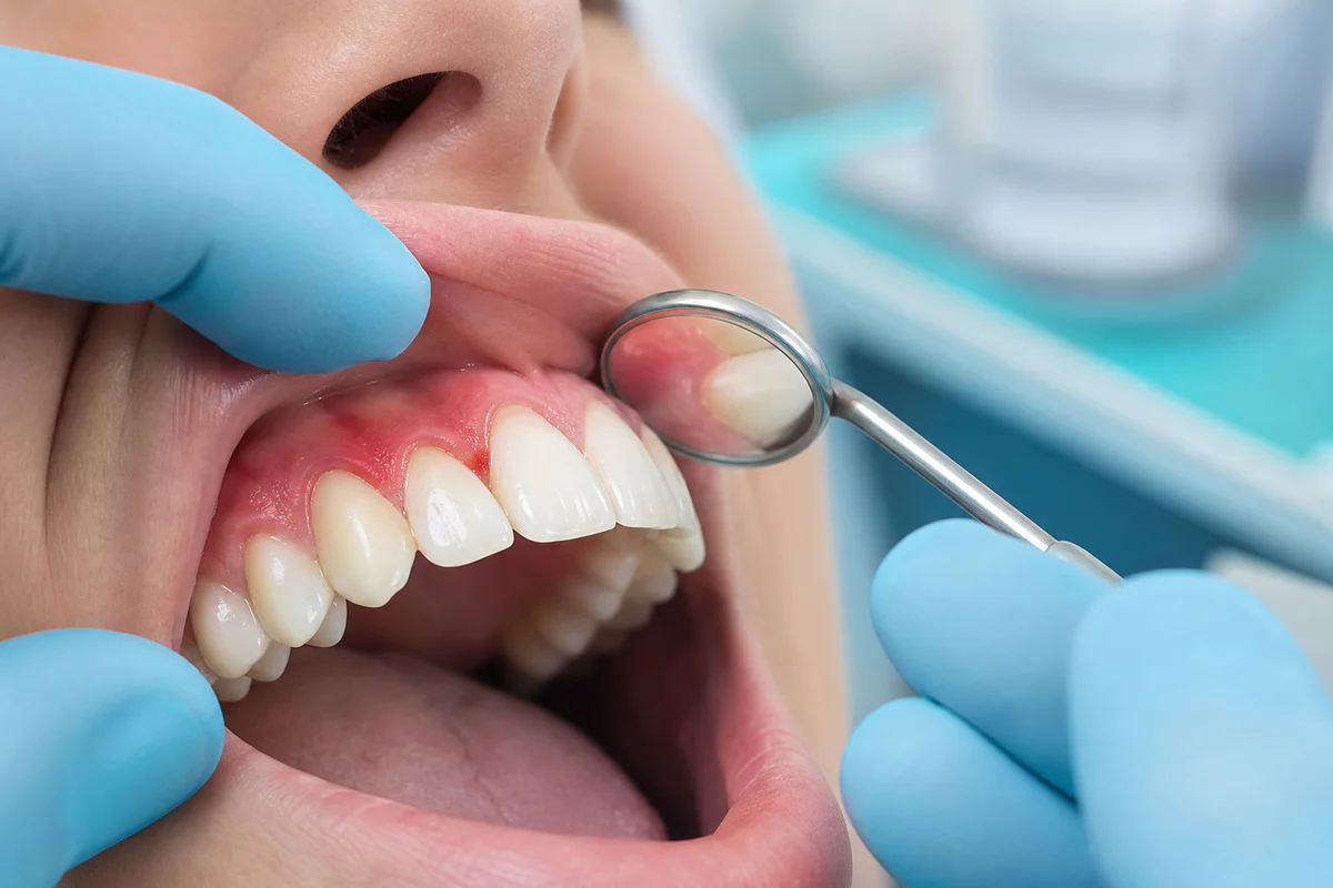 Gingivite ulcero necrotique : 5 signes urgents à connaître