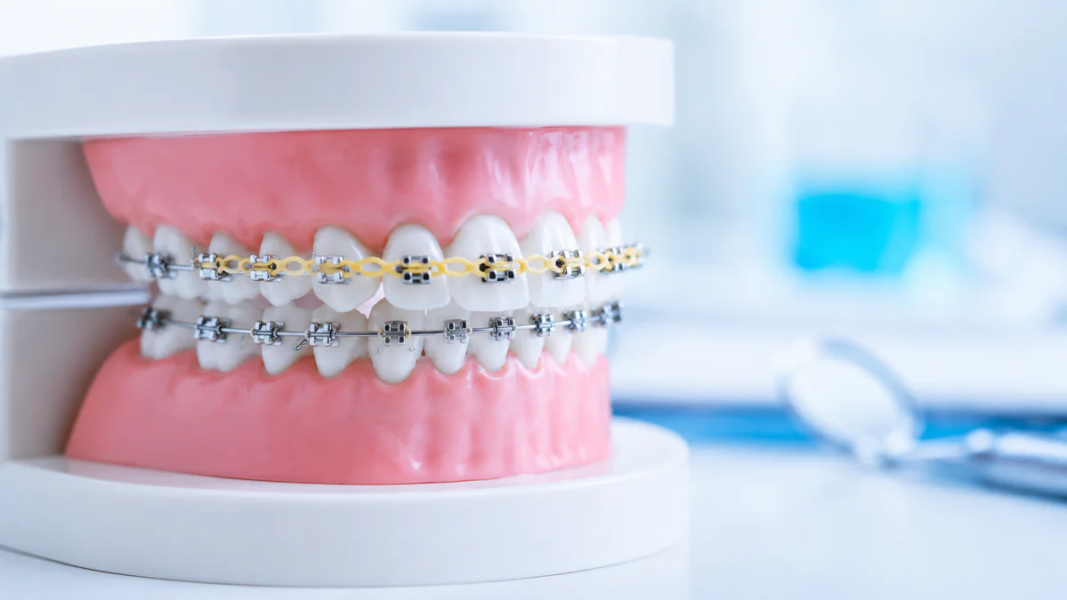 Chainette orthodontie ne sert pas seulement à fermer les espaces dentaires