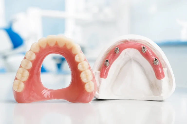 Dentier sans palais : pour qui est-ce vraiment possible ?
