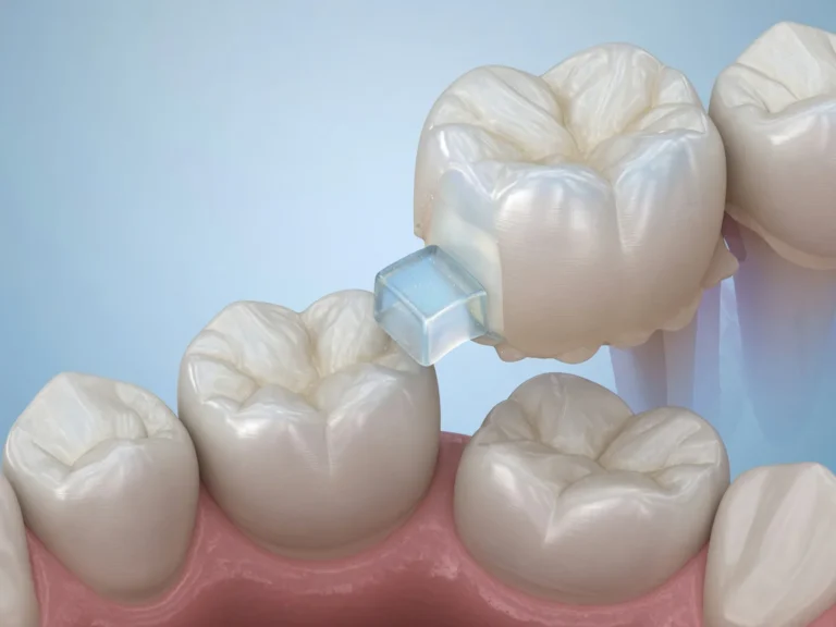 Cale molaire orthodontie, pourquoi cette cale change-t-elle votre morsure ?